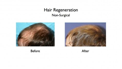 Hair Regeneration before and afters