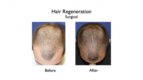 Hair Regeneration before and after