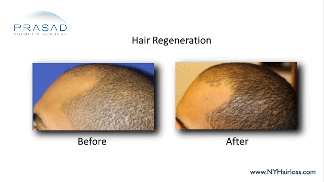 Hair Regeneration before and after