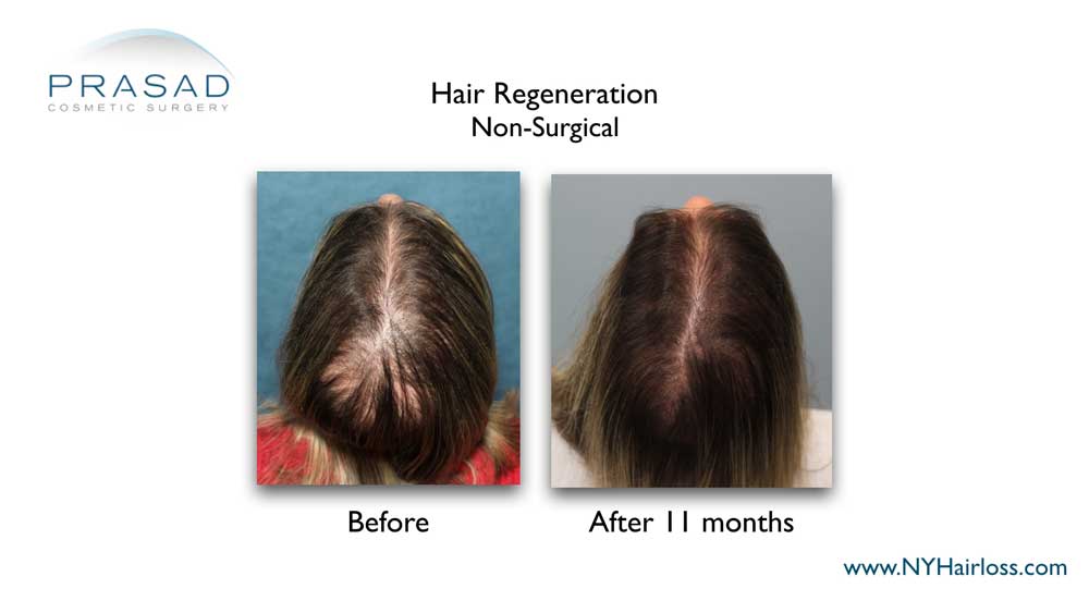 Better diagnosis of female pattern hair loss from other hair loss causes increased success rate of Hair Regeneration ACell PRP to 99% in female androgenic alopecia