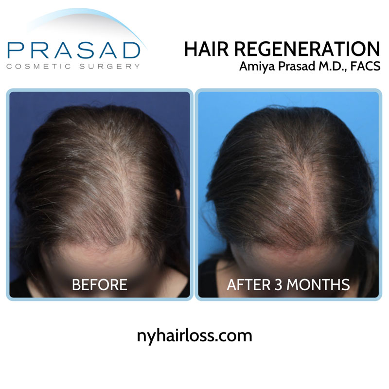 Woman's Astonishing Hair Growth with PRP Hair Loss Treatment - Este