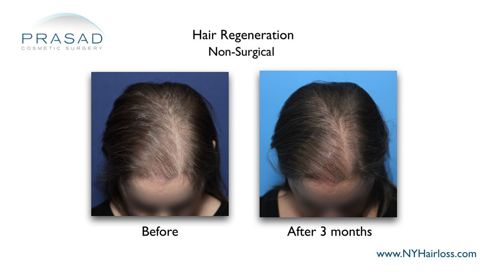 Hair Regeneration treatment on female patterned hair loss before and after 3 months