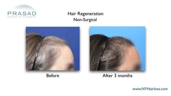 Hair Regeneration Photos - Before and After | New York Hair Loss