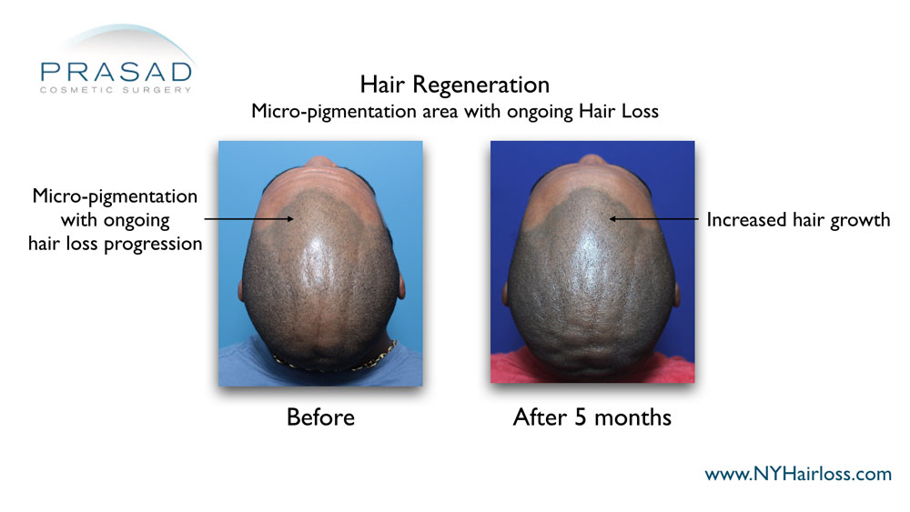 increased hair growth at the frontal hairline after hair regeneration treatment