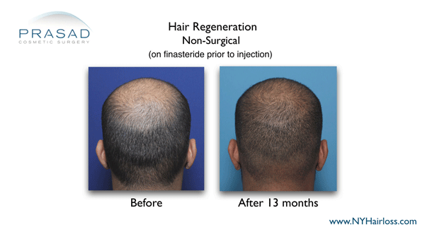 Hair Regeneration performed after patient was on finasteride