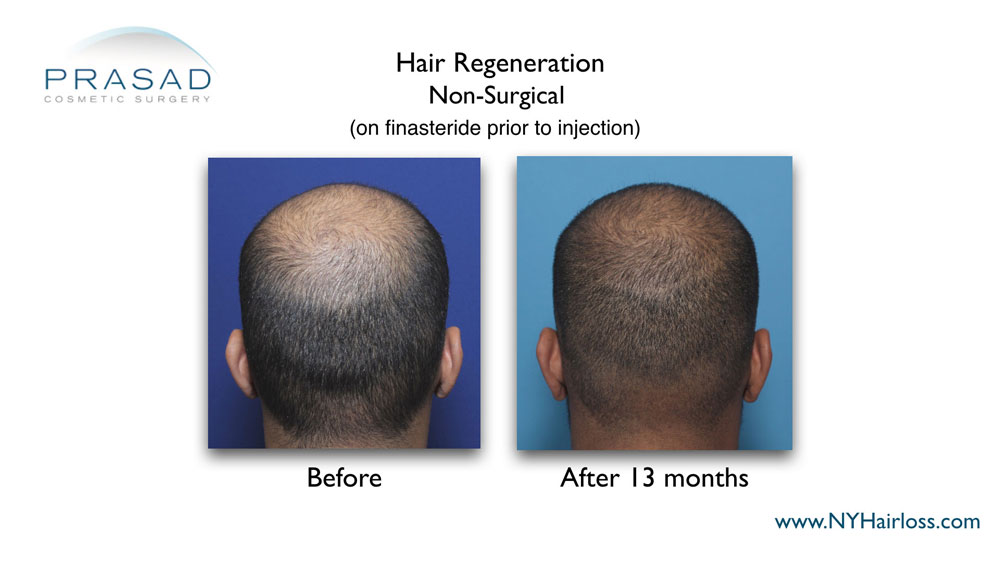 Young man with high-DHT-sensitivity showing results of finasteride alone, and finasteride with Hair Regeneration ACell PRP treatment