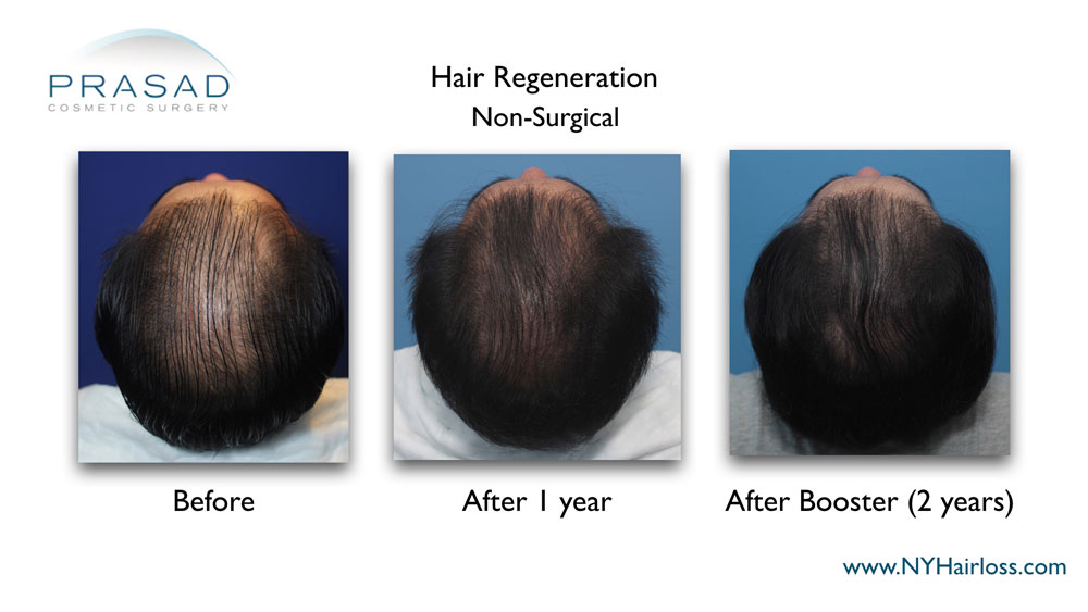 Hair Regeneration ACell PRP patient with advanced hair thinning received two treatments over a year apart to get significantly denser scalp coverage