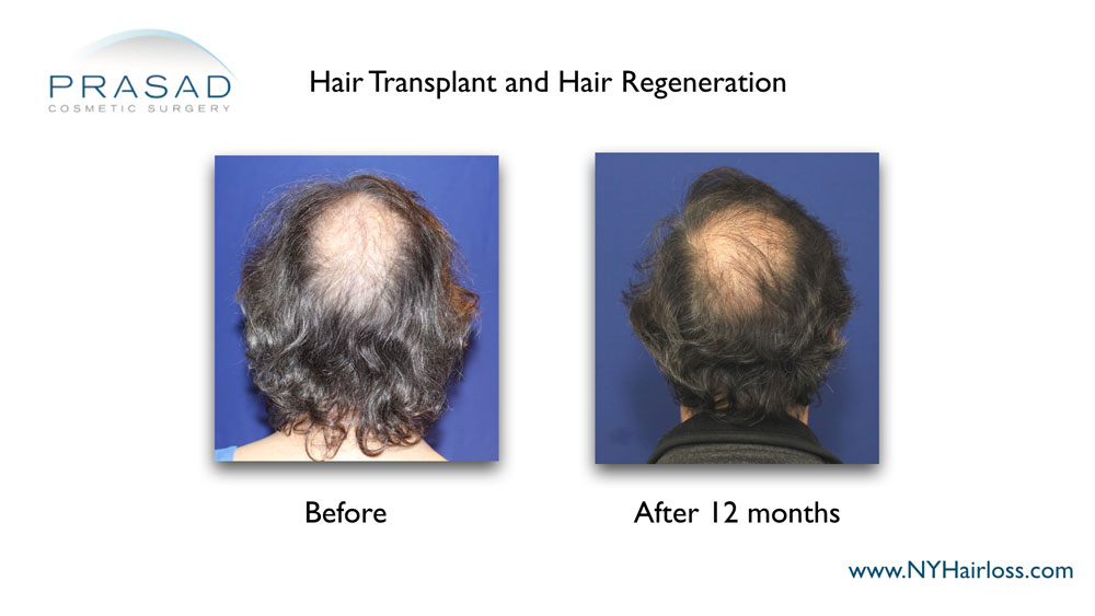 It’s important to have an ACell PRP practitioner who had prior hair loss treatment experience, like Dr. Prasad performing hair transplants and prescribing finasteride