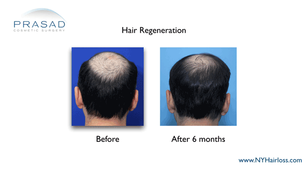 Hair regeneration before and after performed by Dr Amiya Prasad