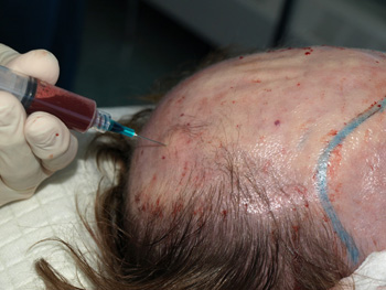 ACell and PRP injected into the scalp