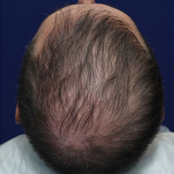 late onset hair loss treatment without Finasteride