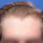 23 yrs old male with early hair loss