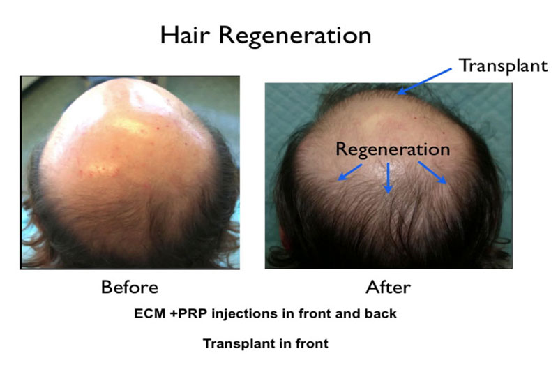 The Hair Regeneration treatment was discovered when Dr. Prasad used ACell to help heal transplanted hair grafts, and found that thinning native hair also grew thicker