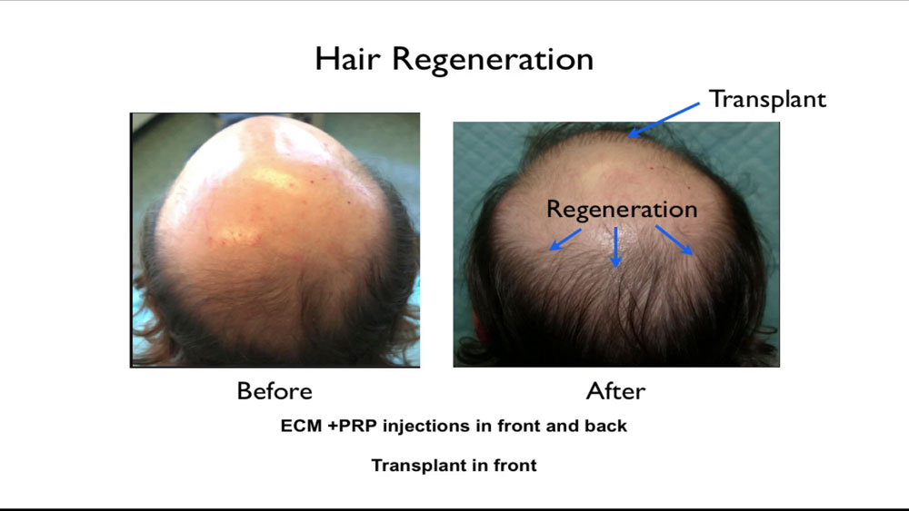 The Hair Regeneration treatment was discovered when Dr. Prasad used ACell to help heal transplanted hair grafts, and found that thinning native hair also grew thicker