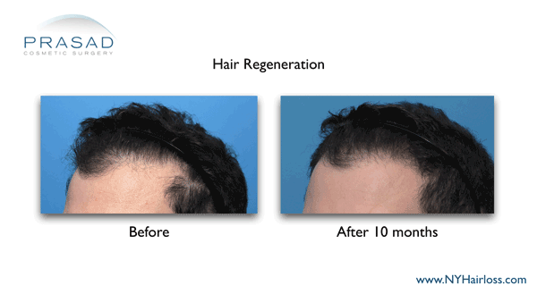 Hair Regeneration before and after 10 month