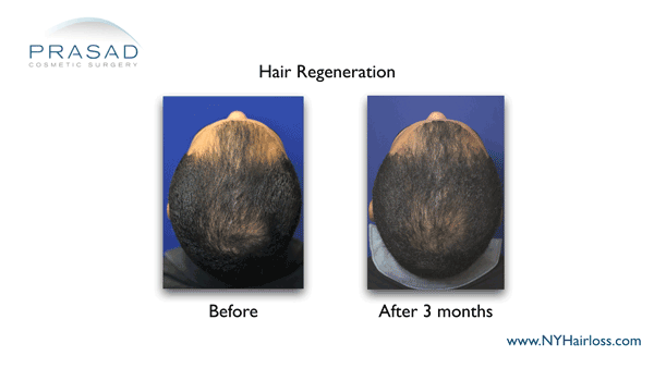 hair regeneration before and after performed by Dr. Prasad