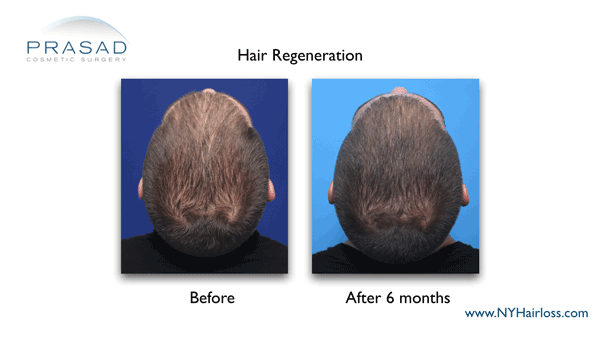 hair regeneration before and after 6 months