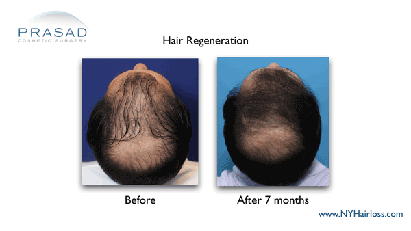 hair regeneration before and after 7 months