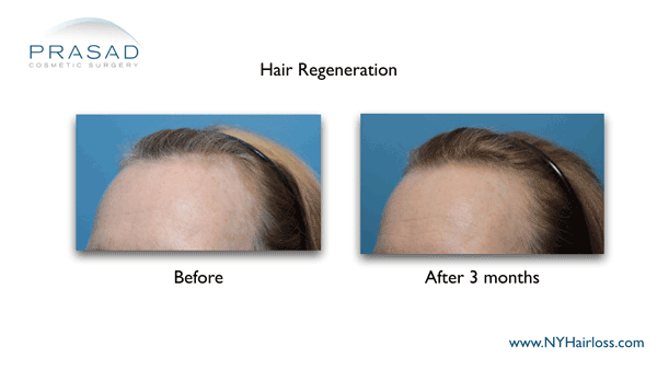 Hair Regeneration female pattern hair loss before-and-after