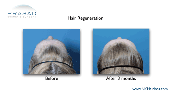Hair Regeneration female pattern hair loss before-and-after 3 months