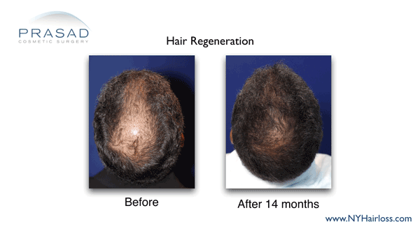 Hair Regeneration before and after 10 months