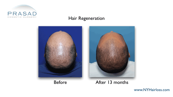 hair regeneration before and after 13 months performed by Amiya Prasad MD