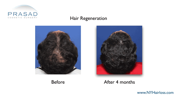 Hair Regeneration top of the head view before and after 4 months performed by Amiya Prasad MD