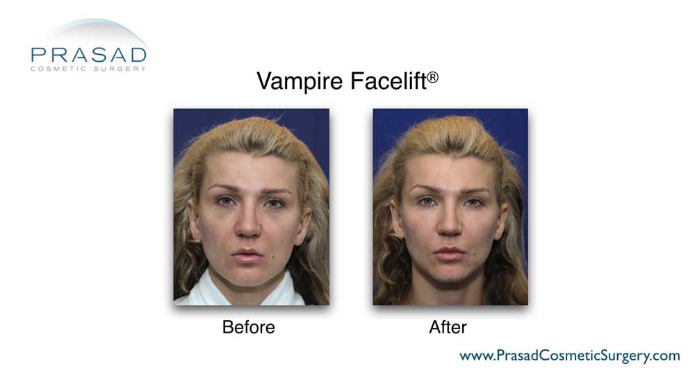 PRP helps in improving skin quality, by itself or combined with other modalities like cosmetic filler in treatments like the Vampire Facelift