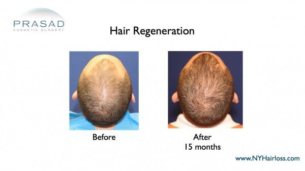 hair regeneration before and after 15 months on male patient