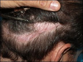 Scarring in old hair transplant donor areas