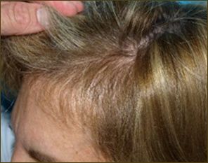 female hair loss 6 months after grafts dipped in ACELL prior to transplant