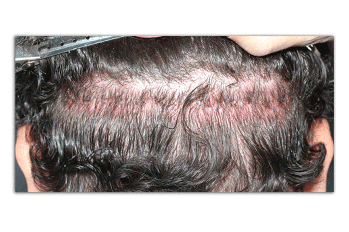 Hair Transplantation and Hair Regeneration | Dr Amiya Prasad | NY