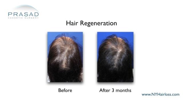 female pattern hair loss treated with hair regeneration before and 3 months after treatment
