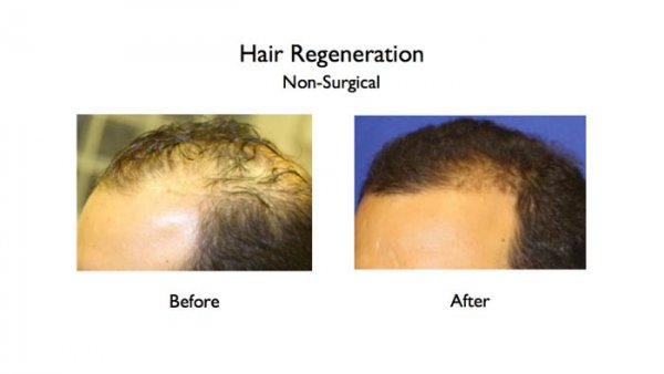 hair loss-acell prp