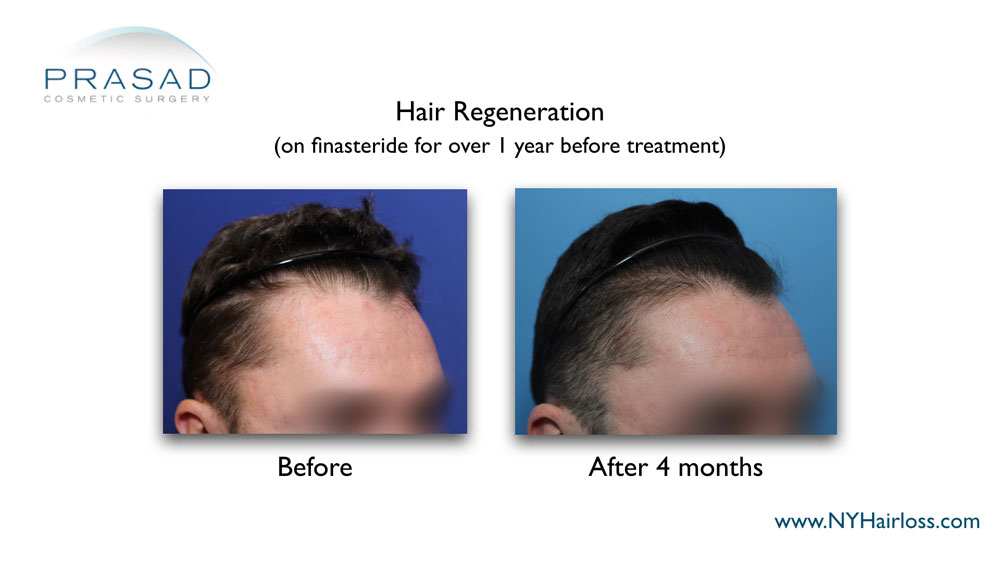 thicker hair growth on frontal hairline 4 months after hair regeneration treatment