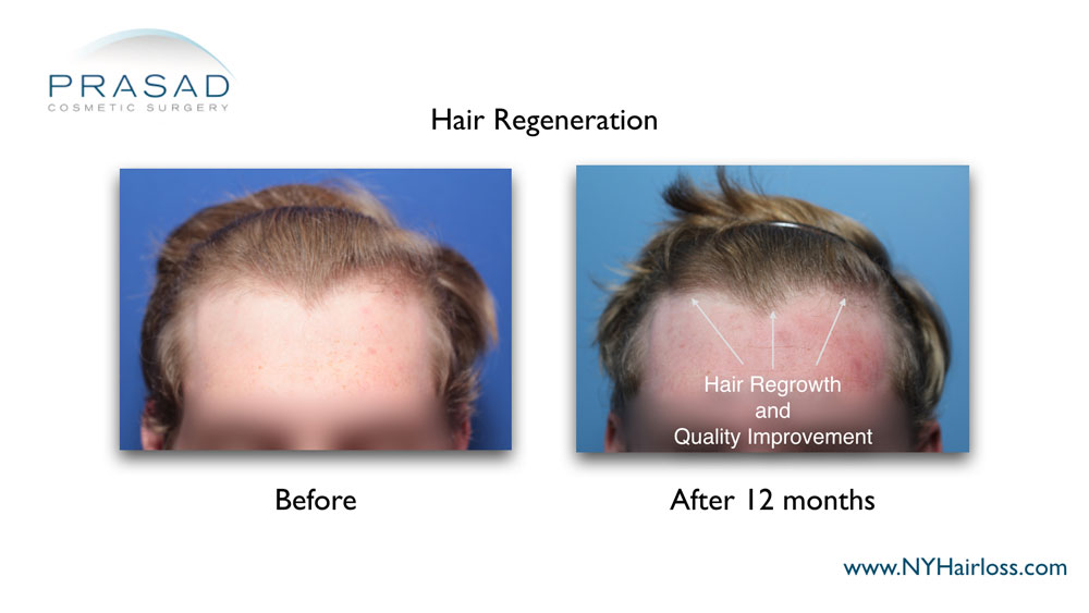 improved thickness and quality of hair 12 months after hair regeneration treatment