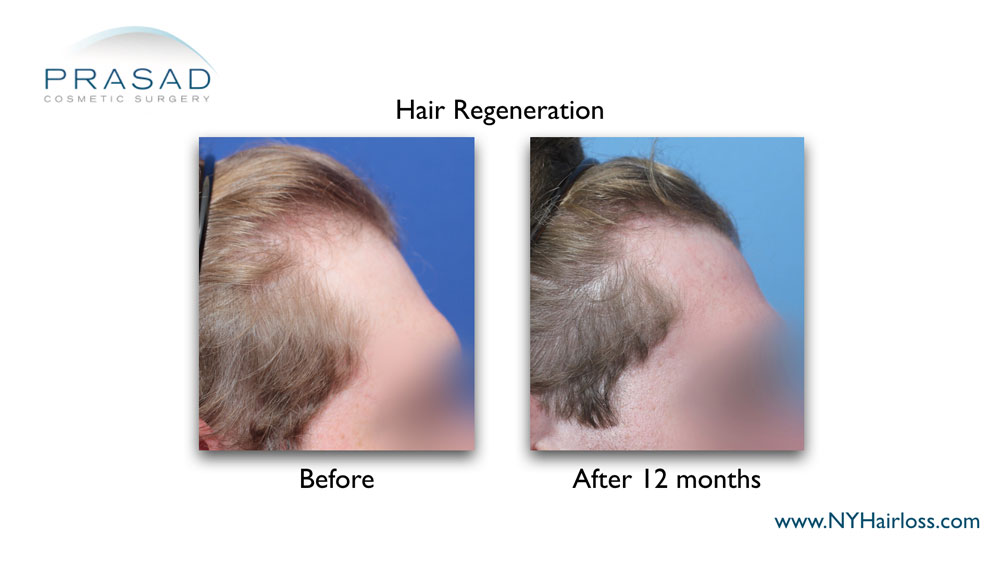 visibly thicker and darker hair on the temples 12 months after the treatment