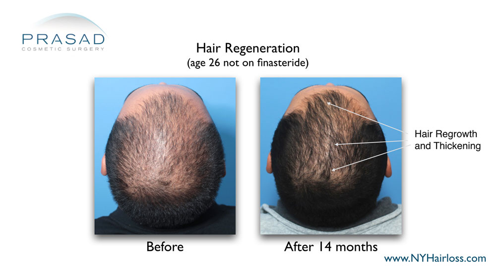 Hair Loss Reasons Medical conditions that can cause hair loss