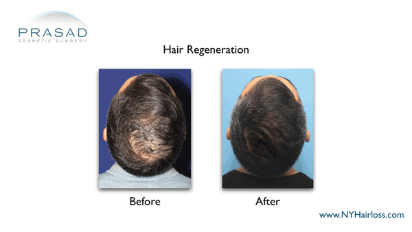 hair regeneration before and after performed by Amiya Prasad MD