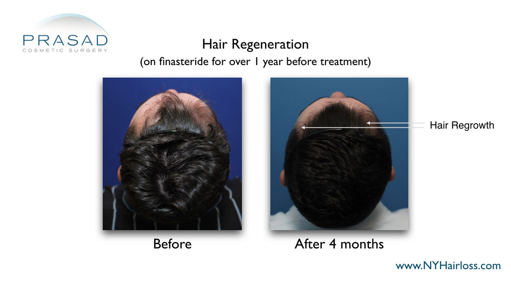 hair density improve 4 months after hair regeneration treatment