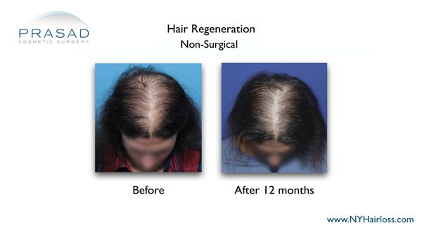 12 months after hair regeneration female
