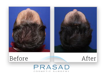 before and after hair regeneration patient photo review