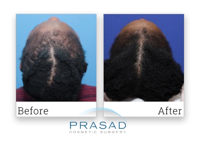 before and after hair regeneration female patient review with photo
