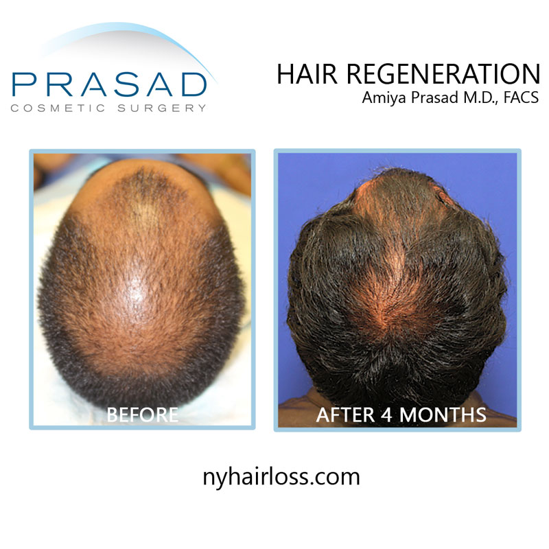 Result of PRP Therapy in Hair loss After 3 Months of Treatment