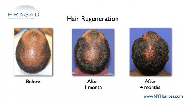 hair regeneration treatment before and after 4 months