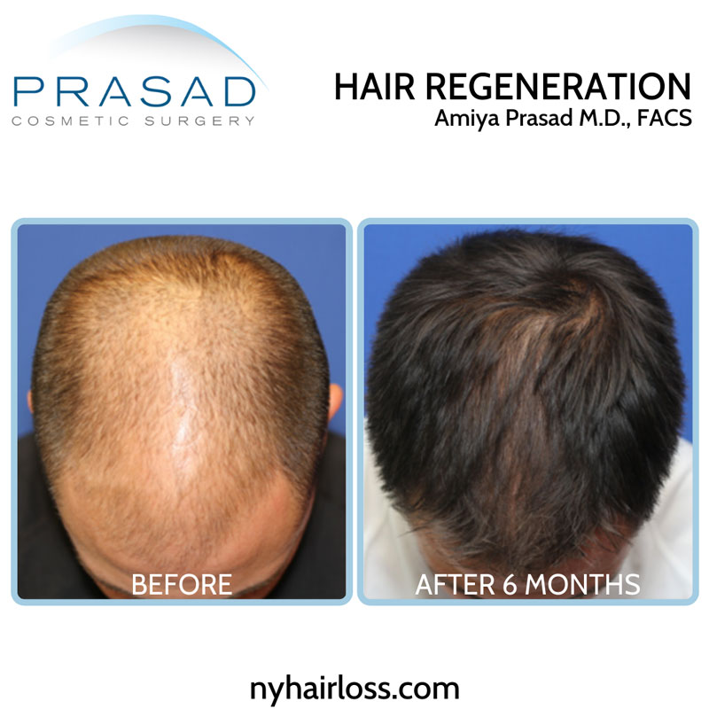 Why ACell + PRP Treatments are Not All the Same | Hair Regeneration