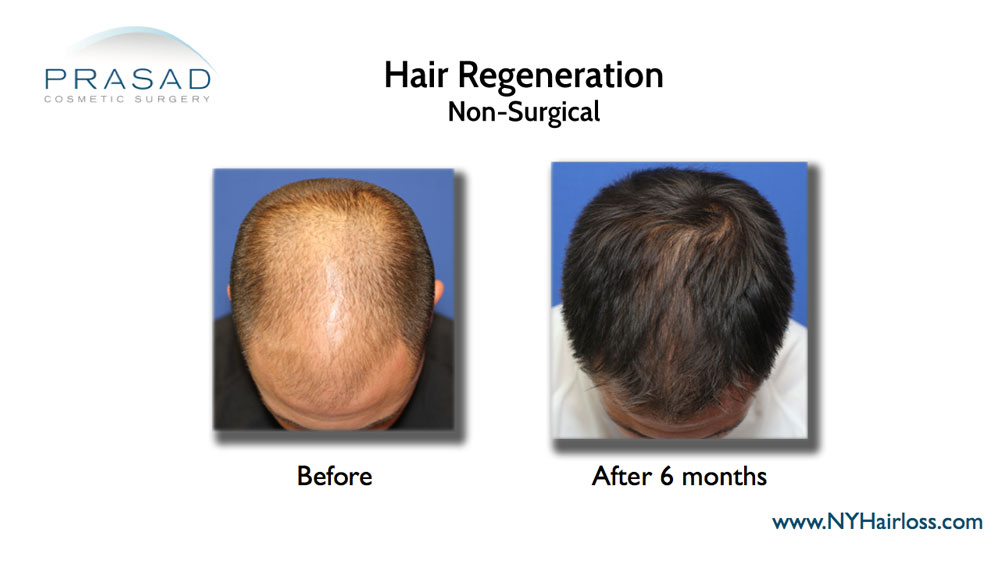 Hair Regeneration PRP ACell before and after pictures have been stolen by other medical practices claiming them as their own, even featured on TV