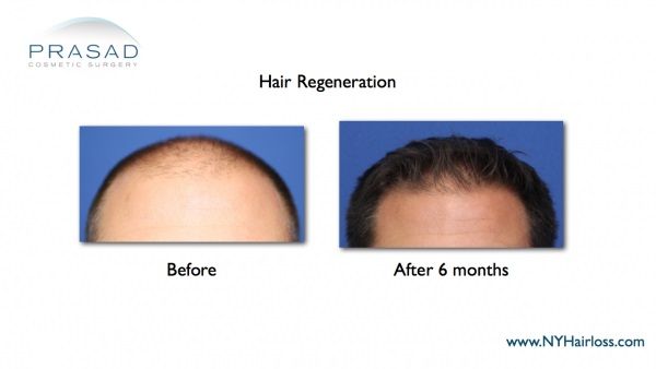 before and 6 months after hair transplant alternative treatment on male patient