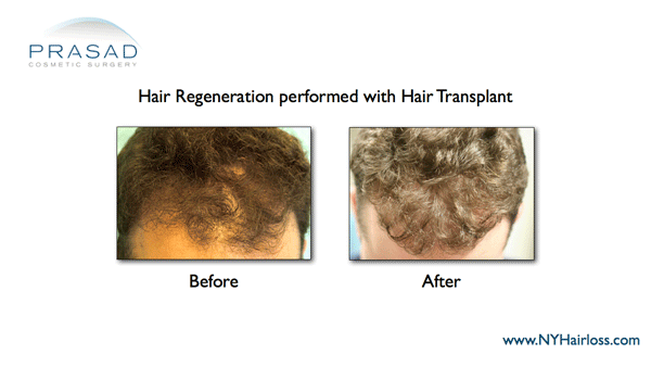 before and after hair regeneration applied to male patient who had a hair transplant