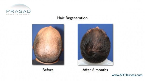 hair regeneration before and after 6 months on male patient